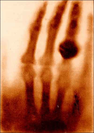 Wilhelm Roentgen first X-ray