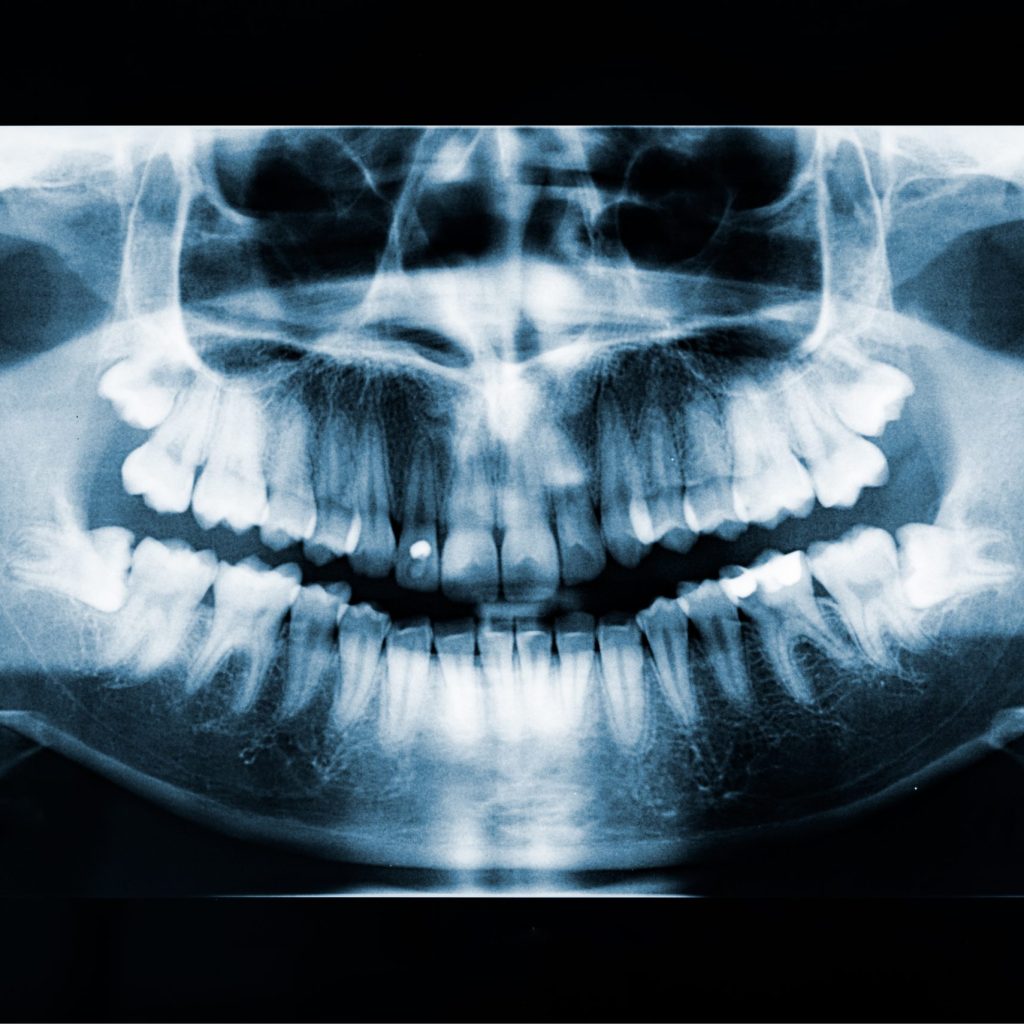 Adult woman panoramic dental x-ray, image of teeth and mouth with both lower wisdom teeth